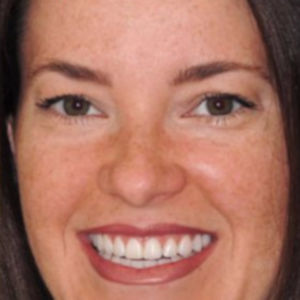 Chipped teeth treated with Porcelain Veneers after 3696268
