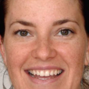 Chipped teeth treated with Porcelain Veneers before 3696268