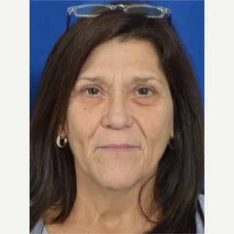 45-54 year old woman treated with Liquid Facelift before 2529962