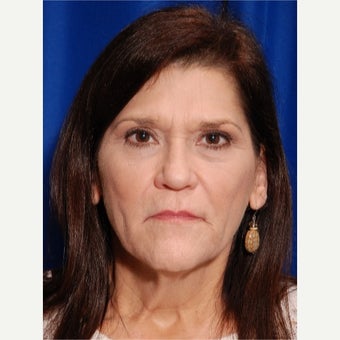 45-54 year old woman treated with Liquid Facelift after 2529962