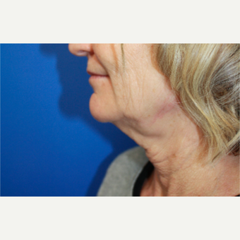 45-54 year old woman treated with Facelift before 3400704