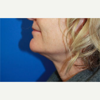 45-54 year old woman treated with Facelift after 3400704