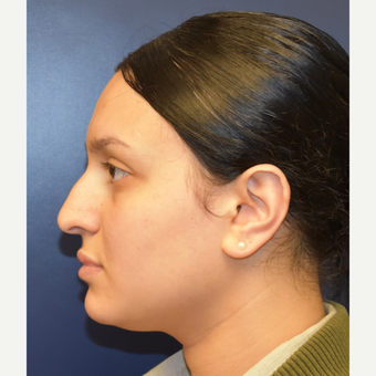 18-24 year old woman treated with Septoplasty before 2979661
