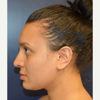18-24 year old woman treated with Septoplasty after 2979661