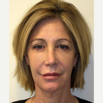 45-54 year old woman treated with Bellafill after 3143331