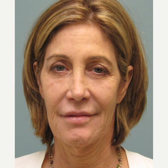 45-54 year old woman treated with Bellafill before 3143331