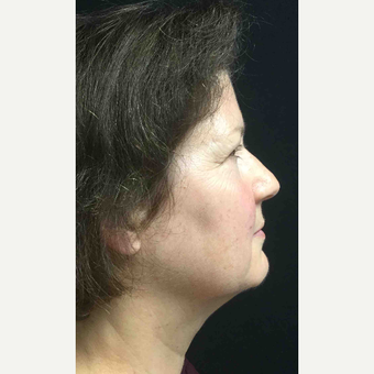 55-64 year old woman treated with Eyelid Surgery before 3218640