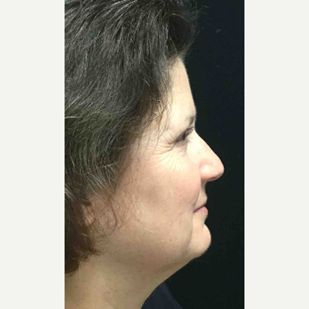 55-64 year old woman treated with Eyelid Surgery after 3218640