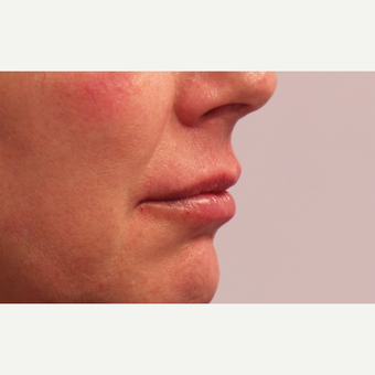 55-64 year old woman treated with Lip Augmentation after 3675125