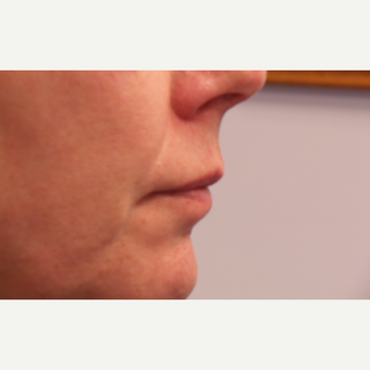 55-64 year old woman treated with Lip Augmentation before 3675125
