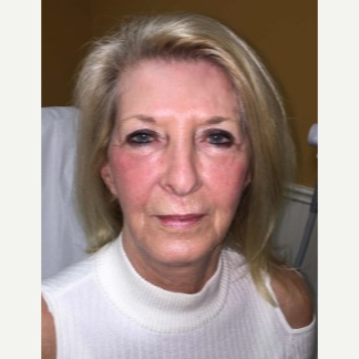 55-64 year old woman treated with Pearl Laser after 3629890