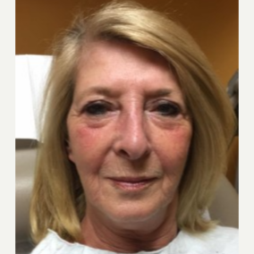 55-64 year old woman treated with Pearl Laser before 3629890