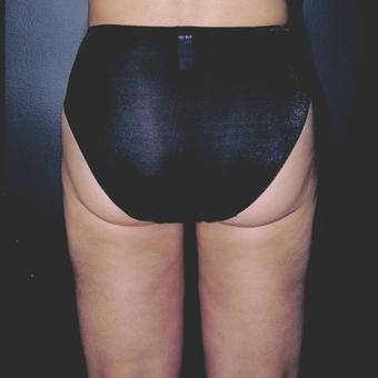 Woman treated with Liposuction did not like the "love handles" and fullness of her inner/outer thigh after 3841261