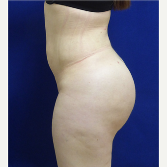 27 y/o female - 1500cc per side Lipo abdomen, flanks, back with fat transfer to the buttocks after 3433799