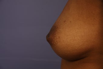 Inverted Nipple Repair before 1429147