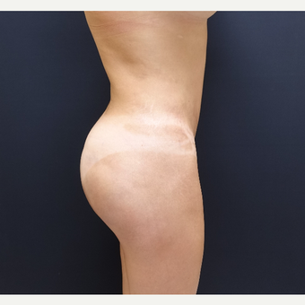 35-44 year old woman treated with 548cc Butt Implants for her Butt Lift after 3235673