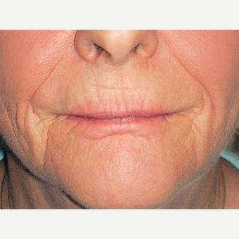 Dermabrasion before 3814118