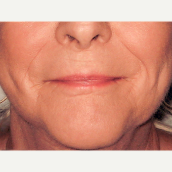 Dermabrasion after 3814118