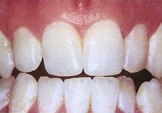 Teeth Whitening (Microabrasion) after 241820