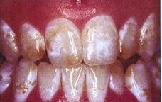 Teeth Whitening (Microabrasion) before 241820