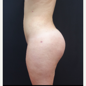 18-24 year old woman treated with Liposculpture after 3315586