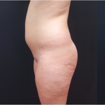 18-24 year old woman treated with Liposculpture before 3315586