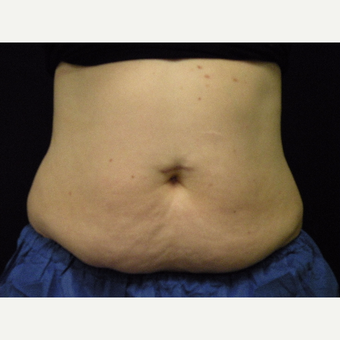 35-44 year old woman treated with CoolSculpting before 3679836