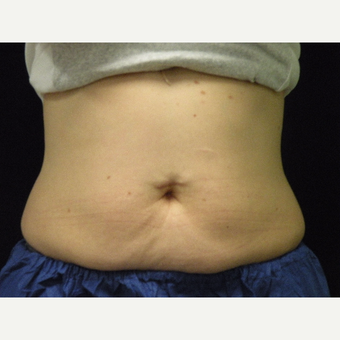 35-44 year old woman treated with CoolSculpting after 3679836