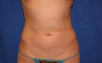 Young woman treated w/ Smartlipo to her abdomen and hips. after 1361162