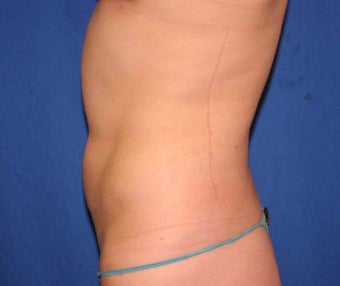 Young woman treated w/ Smartlipo to her abdomen and hips. 1361162
