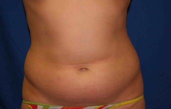 Young woman treated w/ Smartlipo to her abdomen and hips. before 1361162