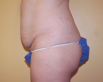 Tummy Tuck before 236152