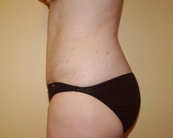 Tummy Tuck after 236152