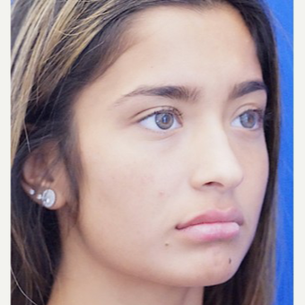 18-24 year old woman treated with Lip Augmentation after 3716277