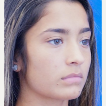 18-24 year old woman treated with Lip Augmentation before 3716277