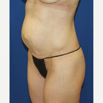 Tummy Tuck before 2436424