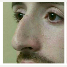 25-34 year old man treated with Rhinoplasty before 3687137