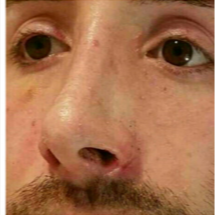 25-34 year old man treated with Rhinoplasty after 3687137