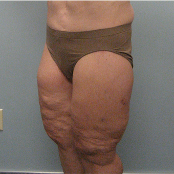 Body Lift after 3680285