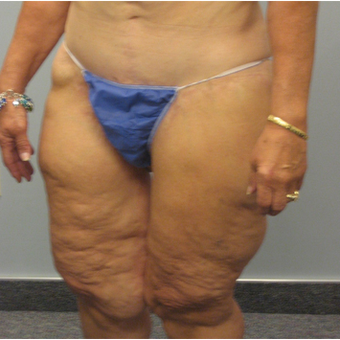 Body Lift before 3680285