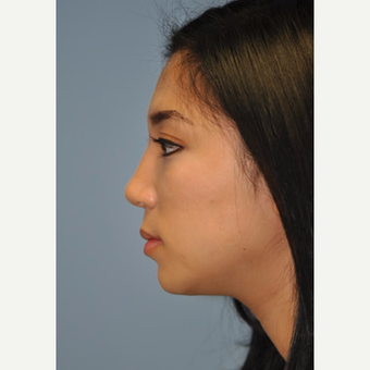 18-24 year old woman treated with Rhinoplasty after 3332395