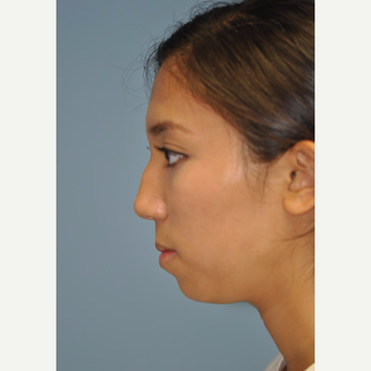18-24 year old woman treated with Rhinoplasty before 3332395