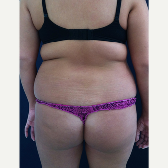 18-24 year old woman treated with Brazilian Butt Lift before 3836250