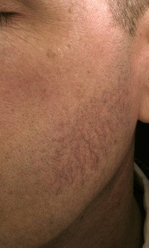 Cheek vessels treated with pulsed dye laser (PDL) before 821640