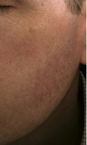 Cheek vessels treated with pulsed dye laser (PDL) after 821640