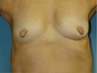 Nipple Reduction before 521330