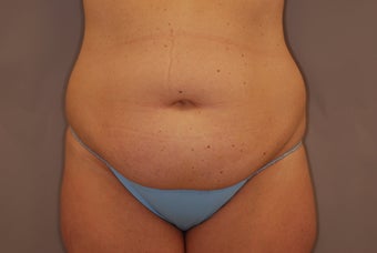 Abdominoplasty 516128