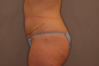 Abdominoplasty after 516128
