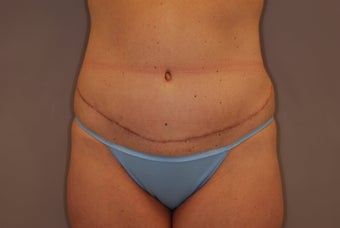 Abdominoplasty 516128