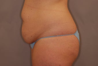 Abdominoplasty before 516128